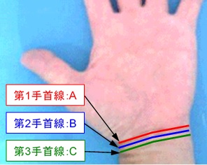 手首線の本数の選択